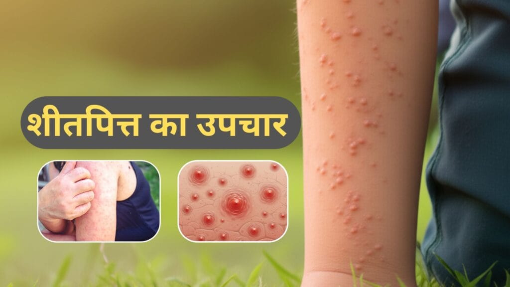 सीतपित्त (Urticaria) लक्षण, कारण और आयुर्वेदिक घरेलू उपाय
